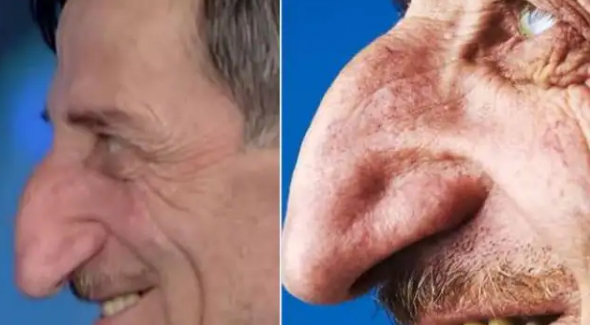 दुनिया में सबसे लंबी है तुर्की के इस शख्स की नाक, 71 साल की उम्र में भी बढ़ती ही जा रही