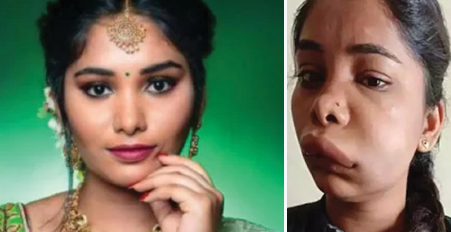 कन्नड़ अभिनेत्री स्वाति सतीश की रूट कैनाल से चेहरा बिगड़ा नौकरी गई, फिल्म भी छिनी