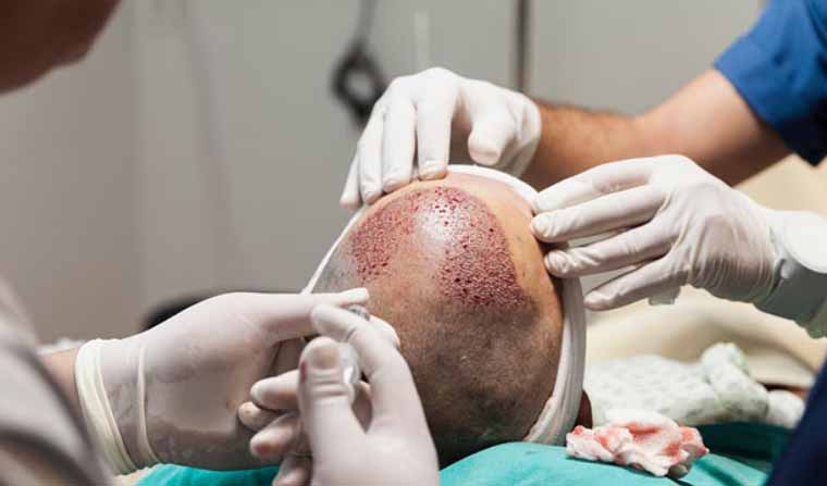 UP: हेयर ट्रांसप्लांट के दौरान असिस्टेंट इंजीनियर की मौत