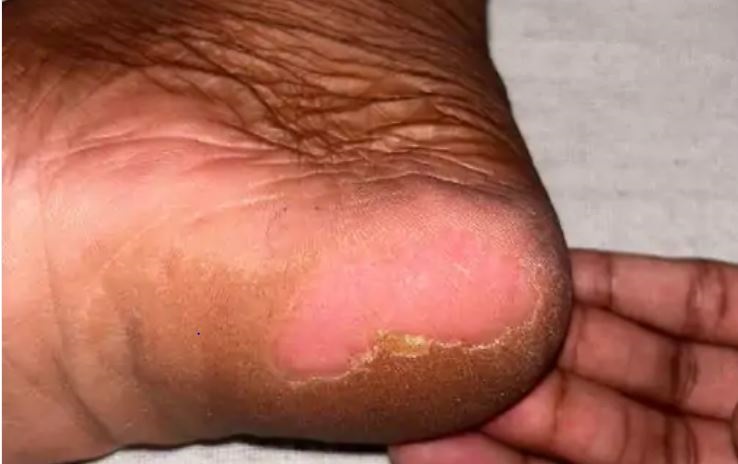 इंदौर के बाद अब जबलपुर के मेडिकल अस्पताल में चूहों ने मरीजों को कुतरा