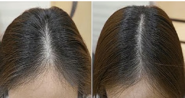 ताइवान के वैज्ञानिकों ने तैयार किया चमत्कारी सीरम 20 दिन में गंजेपन से मुक्ति का दावा
