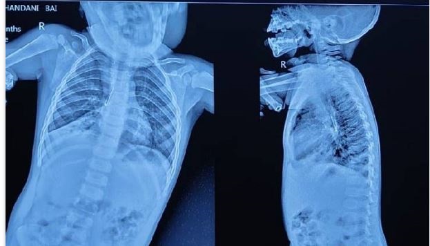 बच्ची के फेफड़े में फंसी एलईडी लाइट, खांसी होने पर कराया एक्सरे