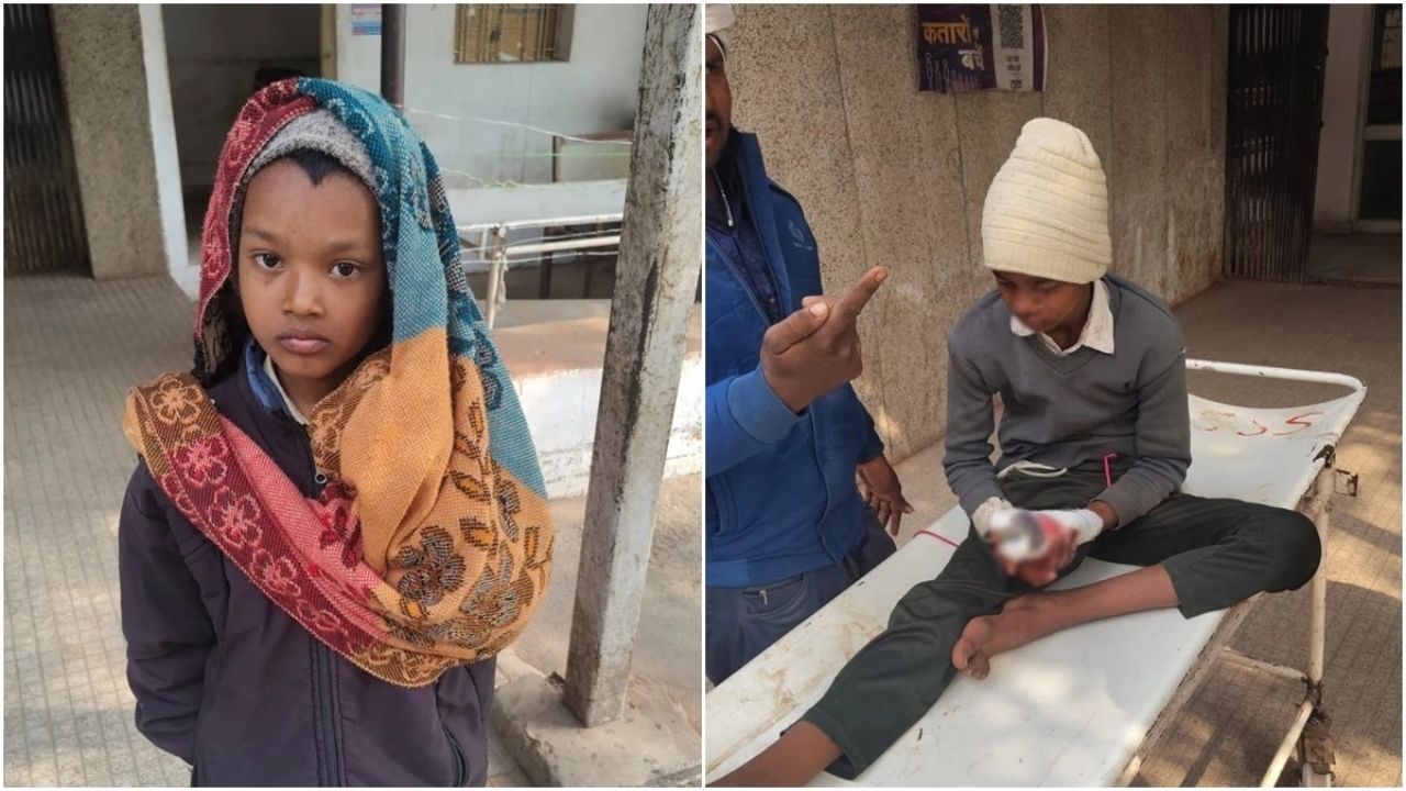 एमपी के रीवा में मोबाइल की बैटरी में ब्लास्ट, दो भाई घायल, बड़े बेटे की उंगलियां उड़ीं, जबलपुर रेफर