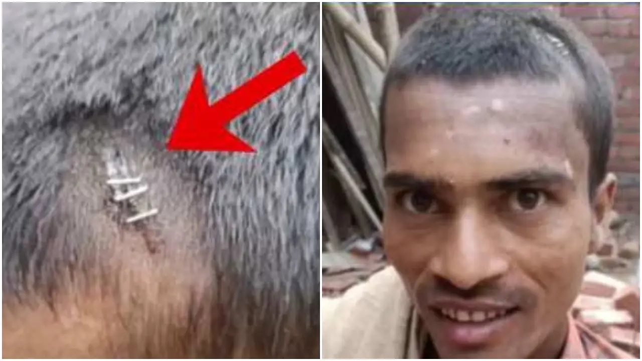 बिहार गजब है : झोलाछाप डॉक्टर ने सिर फटने पर टाकों के बदले ठोंक दिए स्टेपलर पिन