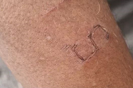 हफ्ता न देने पर ब्लेड से हाथ में दिया एस, जबलपुर के बाल सुधार घर से छूटे नाबालिग का आरोप, सर्चिंग में गांजा-फोन भी मिला